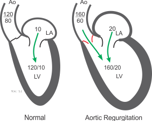 VALV HD005 chamber pressures aortic regurg